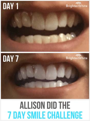 Teeth Whitening Kits by BrighterWhite