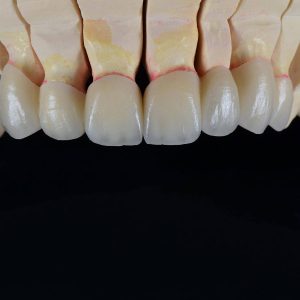 zirconia-bridge-3-300x300.jpg  by hydentallab