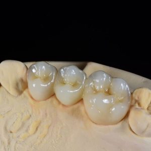layered-zirconia-bridge-1-300x300.jpg  by hydentallab