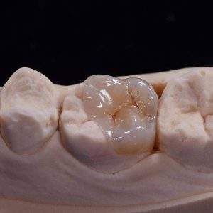 Emax-onlay.jpg  by hydentallab