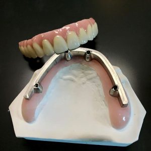 implant-bridge-1-300x300.jpg  by hydentallab