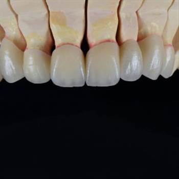 zirconia-bridge-3-300x300.jpg by hydentallab