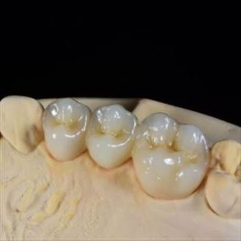 layered-zirconia-bridge-1-300x300.jpg by hydentallab