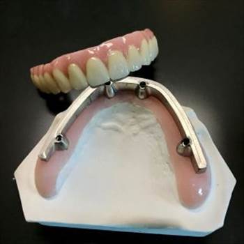 implant-bridge-1-300x300.jpg by hydentallab