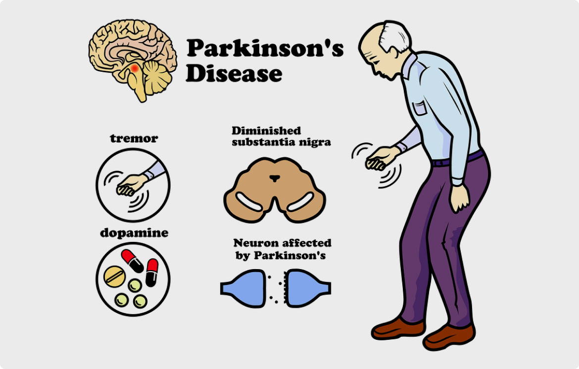 Parkinson's Disease Treatment in Singapore Zhao Neurology.jpg  by zhaoneurology