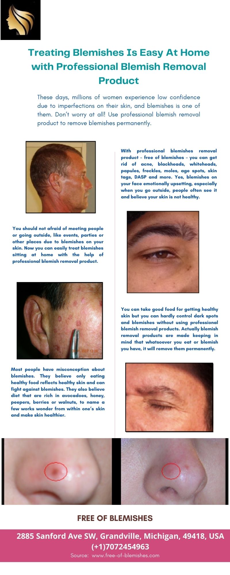 Treating Blemishes Is Easy At Home with Professional Blemish Removal Product.jpg  by freeofblemishesusa