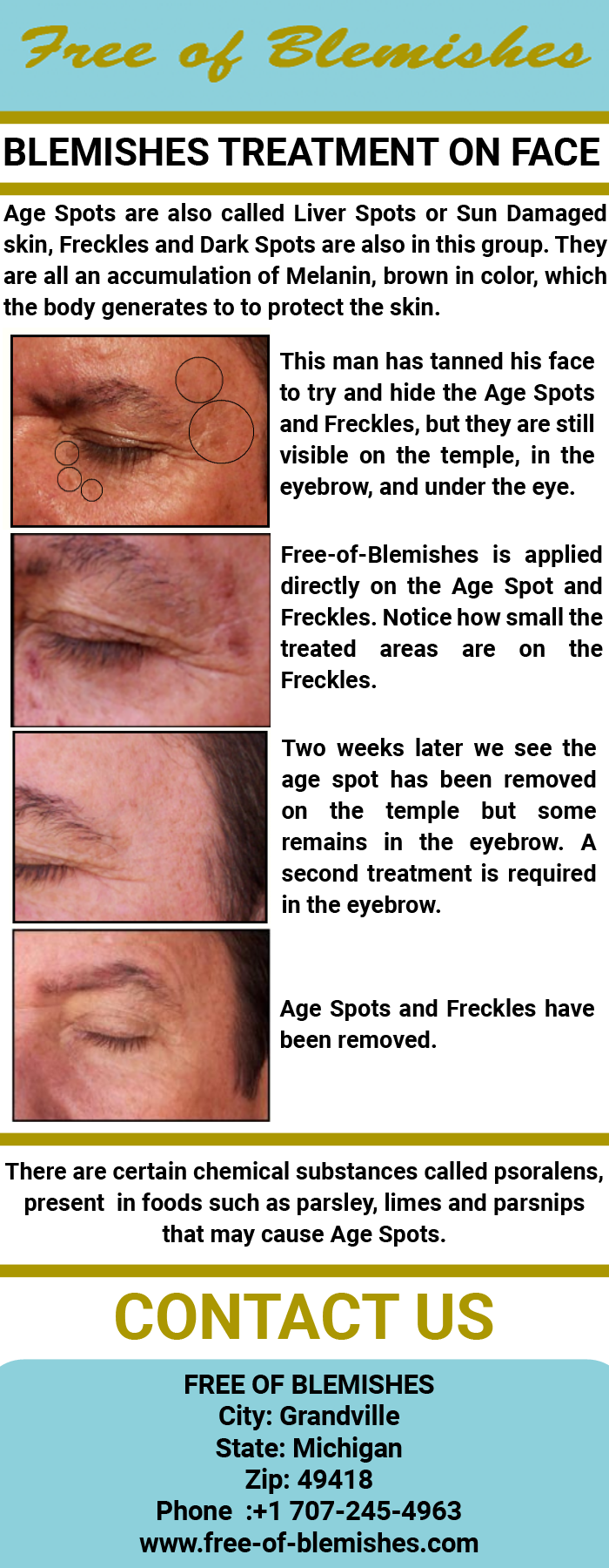Blemishes treatment on face  by freeofblemishes