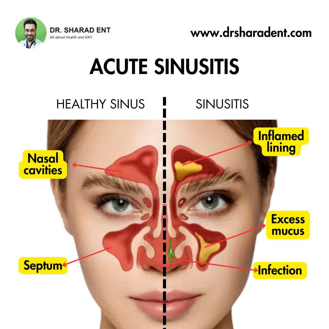 ACUTE SINUSITIS - Dr Sharad ENT.png  by Dr Sharad