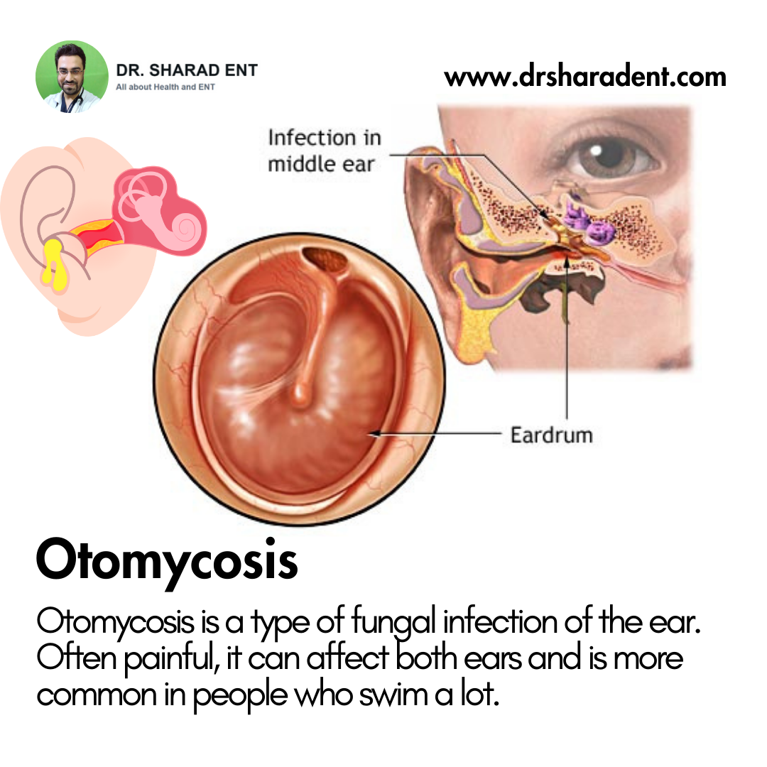 Otomycosis - Dr Sharad ENT.png  by Dr Sharad