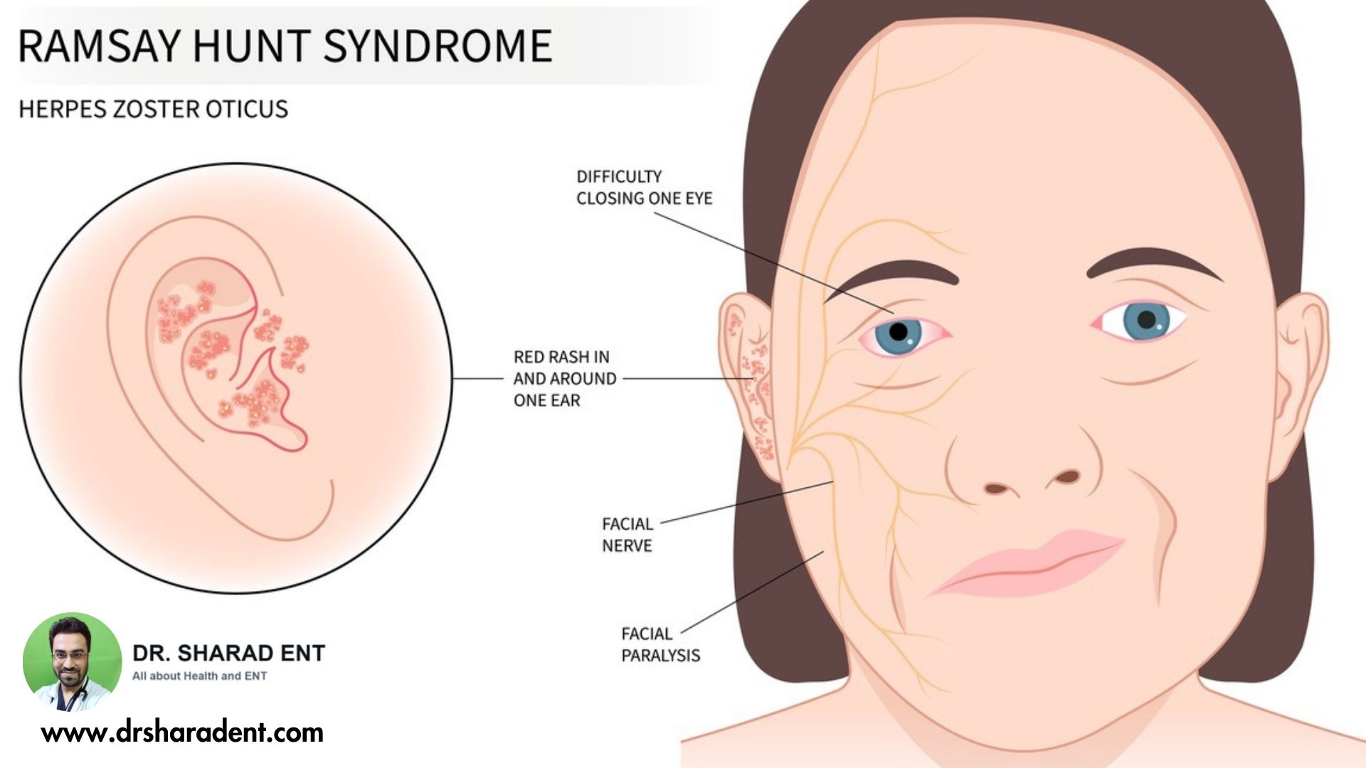 shingles and herpes zoster oticus from chickenpox to facial nerve paralysis.jpg  by Dr Sharad