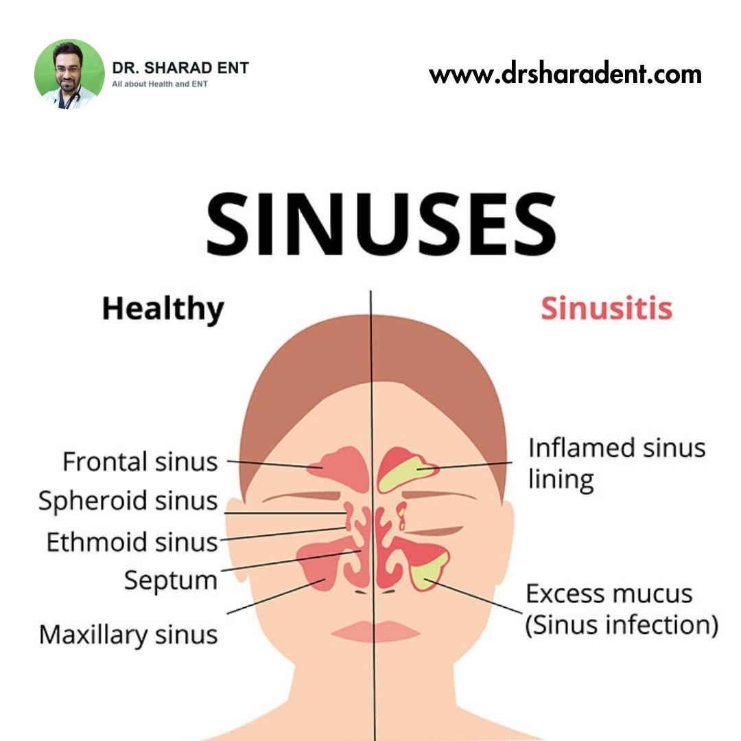 Top Solutions for Relieving Sinus Pressure - Dr. Sharad ENT.jpg  by Dr Sharad