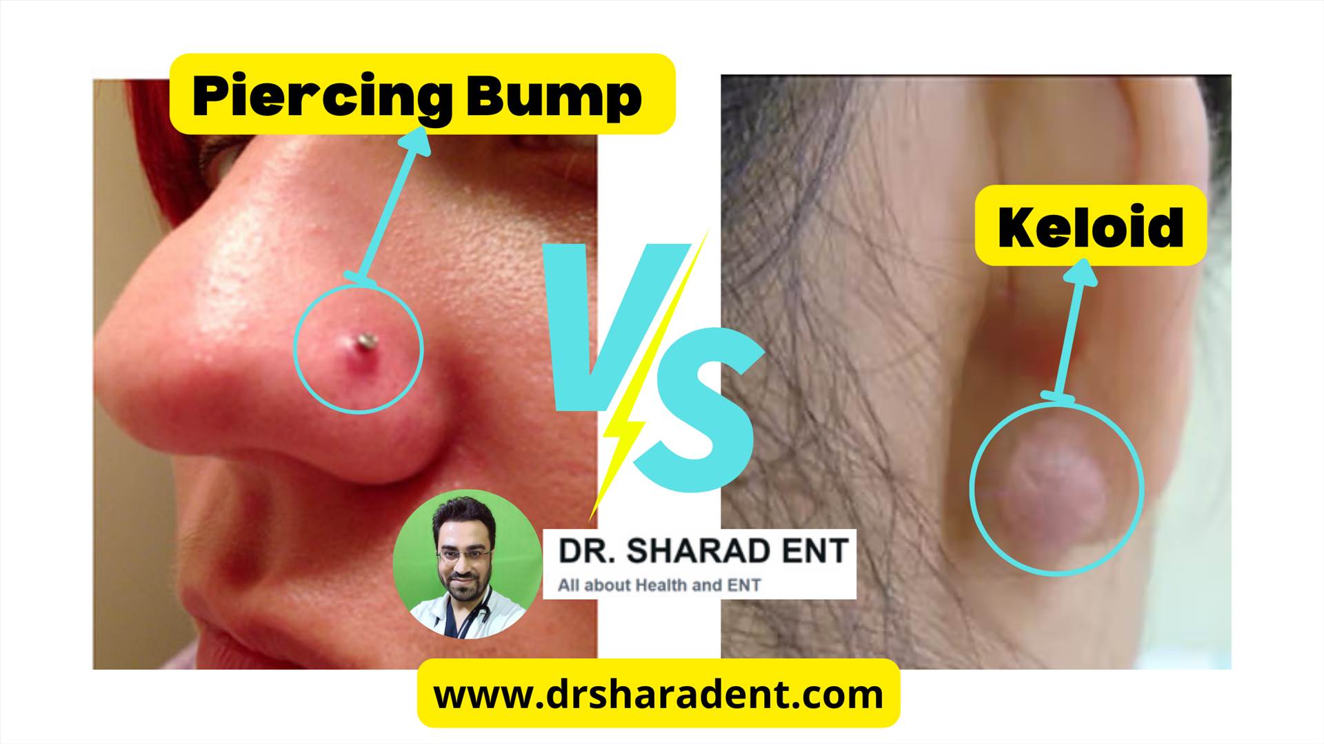 piercing bump vs keloid.png  by Dr Sharad