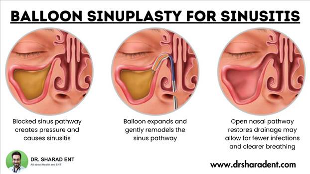 Balloon Sinuplasty For Sinusitis.png by Dr Sharad