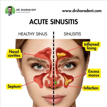 Discover effective treatments for acute sinusitis, including proven methods for rapid relief and expert tips for alleviating symptoms quickly.

Visit - https://www.drsharadent.com/acute-sinusitis-proven-treatment-for-very-rapid-relief/