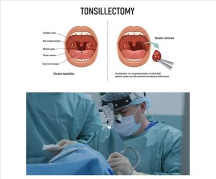 After a tonsillectomy surgery, it's crucial to prepare for the recovery process. What should you expect? Knowing the typical symptoms and recovery process will help you manage the healing process with confidence.

For More Info. Visit- https://www.drsha