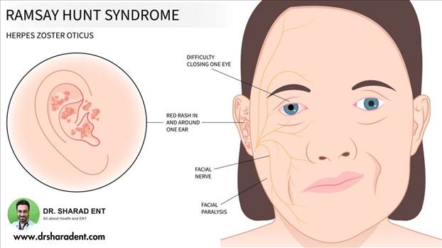 shingles and herpes zoster oticus from chickenpox to facial nerve paralysis.jpg by Dr Sharad
