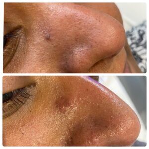 Laser removal of skin tag Are you looking for perfect removal of all benign skin lesions in only a single treatment session?  Visit: https://laserlightskinclinic.co.uk/skin-tag-mole-removal/
 by Laserlightskinclinic