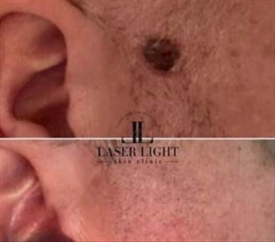 Skin tag removal clinic Goodmayes  by Laserlightskinclinic
