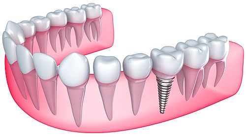 Dental Implants Waco TX Dentists in Waco Family Dentistry offers mini dental implants. These implants are narrower than the traditional dental implant and more effective. https://wacofamilydentistry.net/ by Waco Family Dentistry