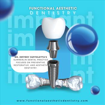 Dental implants Summerlin - Visit : https://www.functionalaestheticdentistry.com/dental-implants/\r\n