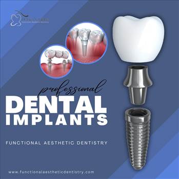 Dental Implants a Paradigm Shifts in Modern Dentistry - Visit : https://www.functionalaestheticdentistry.com/dental-implants/\r\n