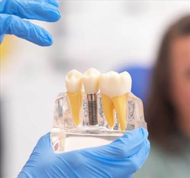 Teeth Savers is undeniably the most reliable and foremost dental clinic offering top-of-the-line veneers in Tijuana.  Visit: https://teethsavers.com/veneers/