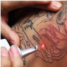 Laser Tattoo Removal Bangalore.jpg  by Dermasolutions