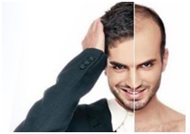 Best Hair Transplant in Bangalore.jpg  by Dermasolutions