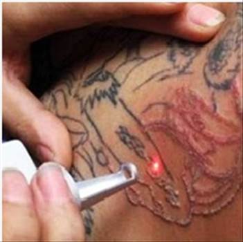 Laser Tattoo Removal Bangalore.jpg by Dermasolutions
