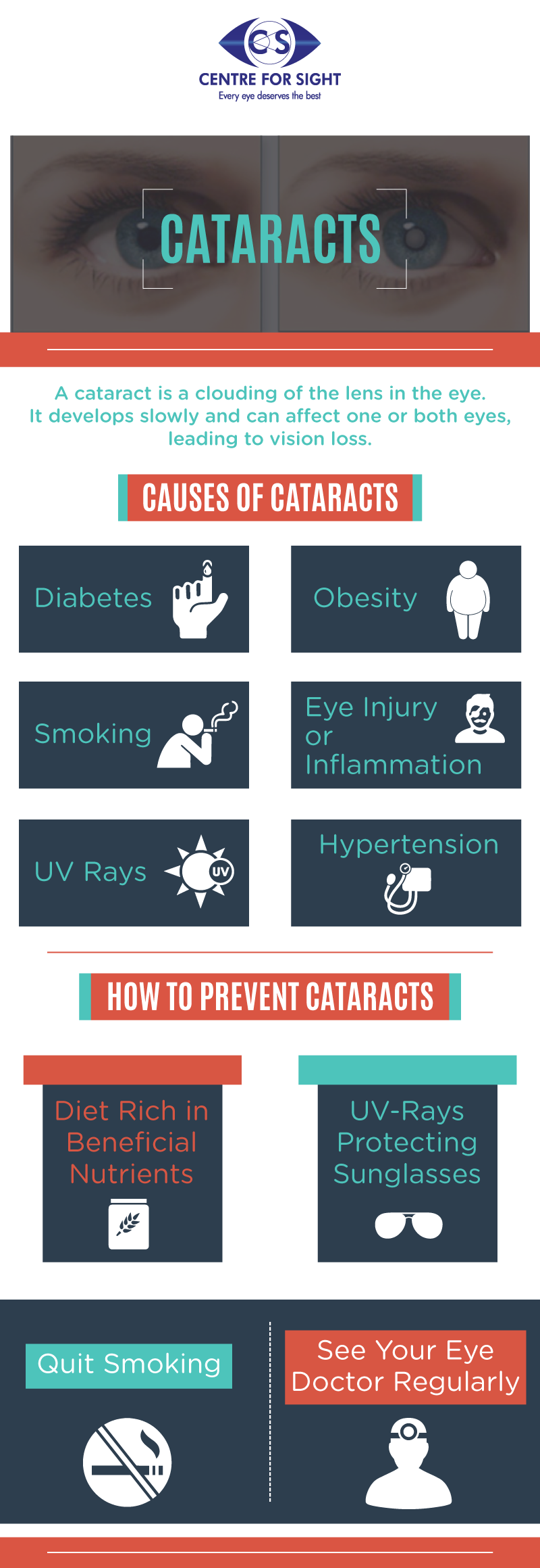 Cataracts A cataract is clouding of the lens in the eye. It develops slowly and can affect one or both eyes, leading to vision loss.

http://www.centreforsight.net/ by centreforsight