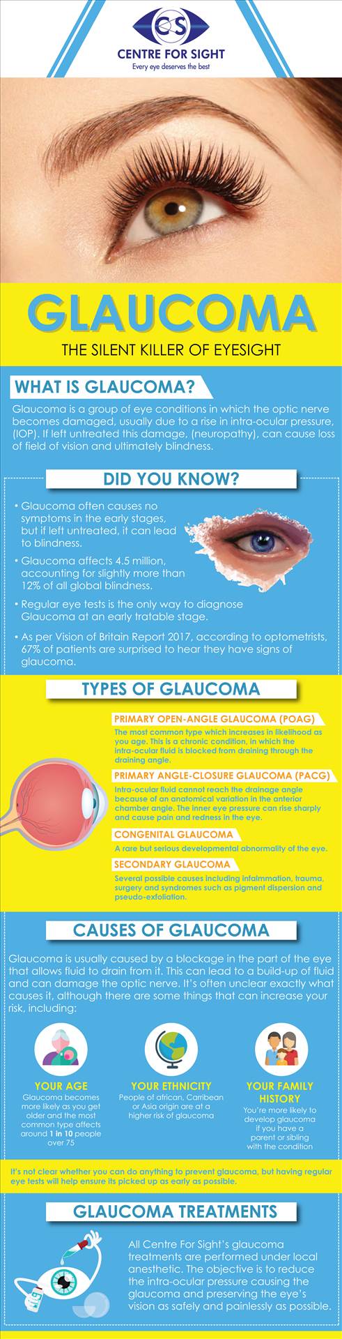 What is Glaucoma Glaucoma is a group of eye conditions in which the optic nerve becomes damaged, usually due to a rise in intra-ocular pressure, (IOP). If left untreated this damage, (neuropathy), can cause loss of field of vision and ultimately blindness. by centreforsight