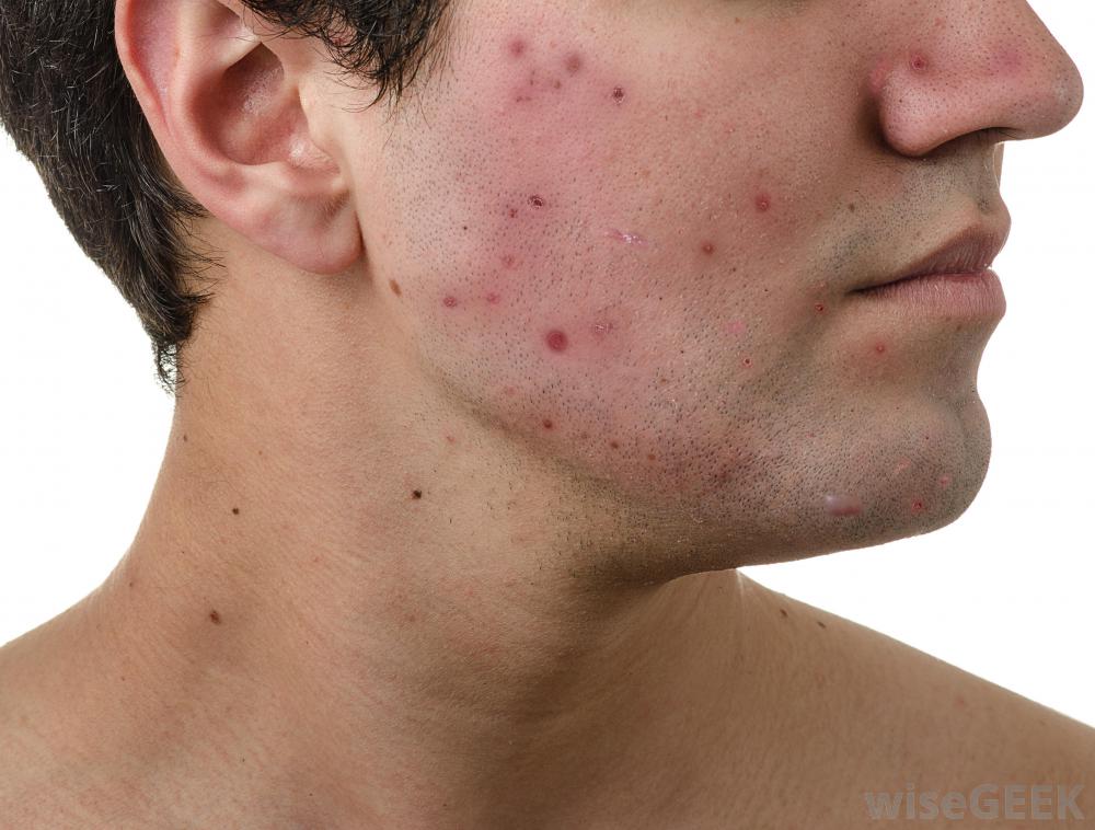 Skin Care Tips for Men to Fight Acne.jpg  by neweraskin