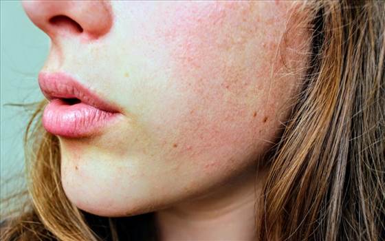 Top Five Tips to Avoid Getting Dry Skin in Winter.jpg by neweraskin