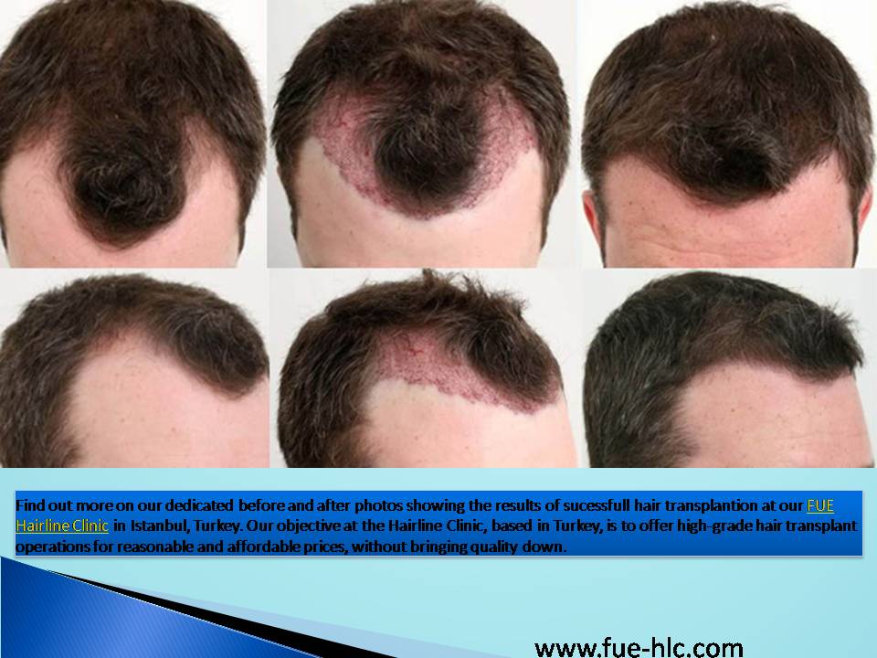 Hair Transplant Before After.JPG  by FueHlc