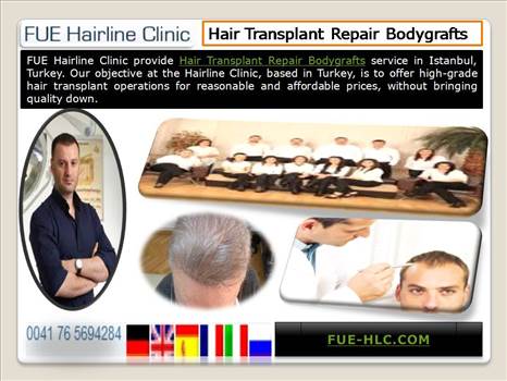 Fue Hair Transplant Turkey.JPG by FueHlc